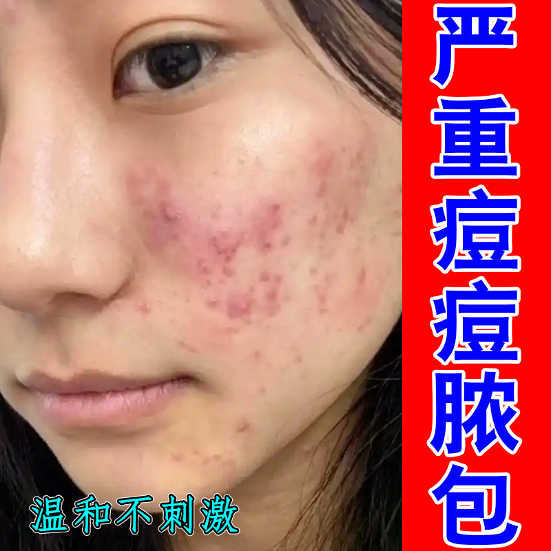 严重痘痘脓包脸上长小疙瘩颗粒麻麻赖赖上火熬夜内分泌失调修护药