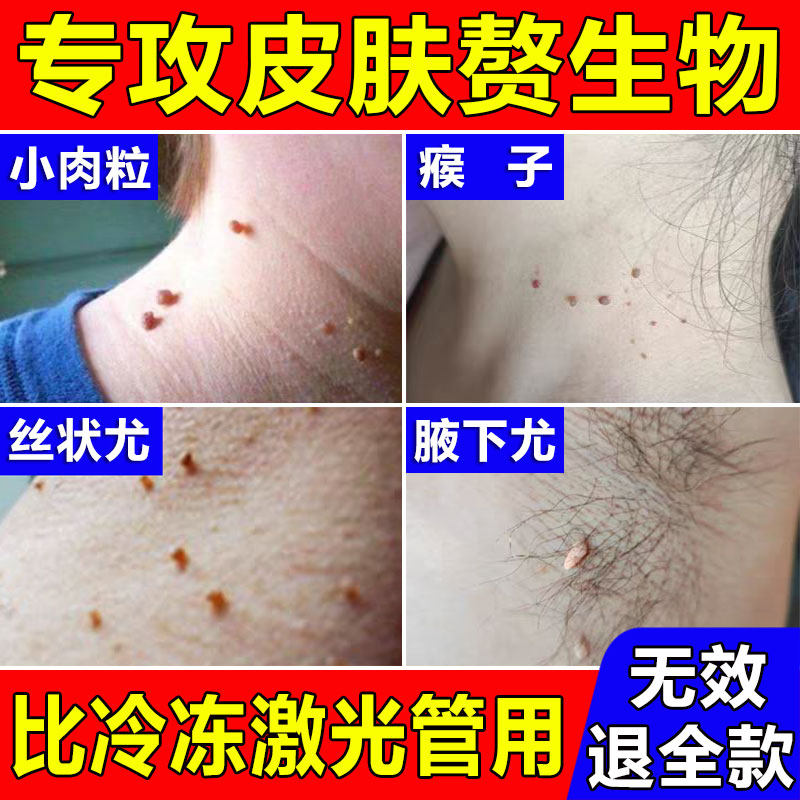 脖子上长小肉粒疙瘩药点跖疣猴去瘊灵膏祛除扁平神器丝状一抹无忧