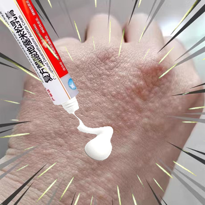 【严静舒】复方醋酸地塞米松乳膏20g*1支/盒