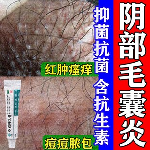 外阴部私处毛囊炎瘙痒真菌感染长痘痘脓包止痒专用药膏克霉唑M1