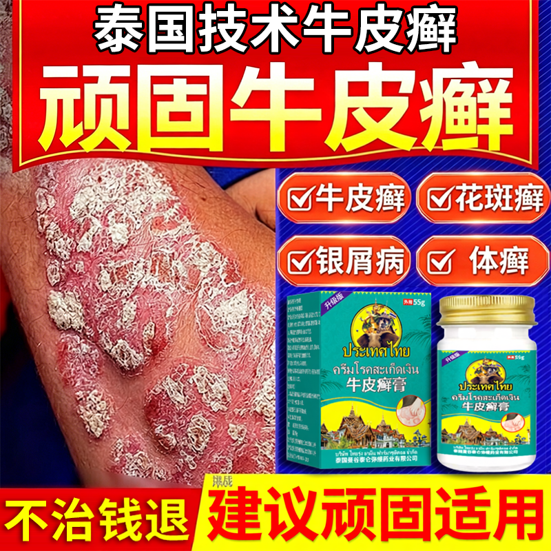 泰国治顽固性牛皮藓银屑病效特专外用膏药皮肤真菌感染杀菌膏药