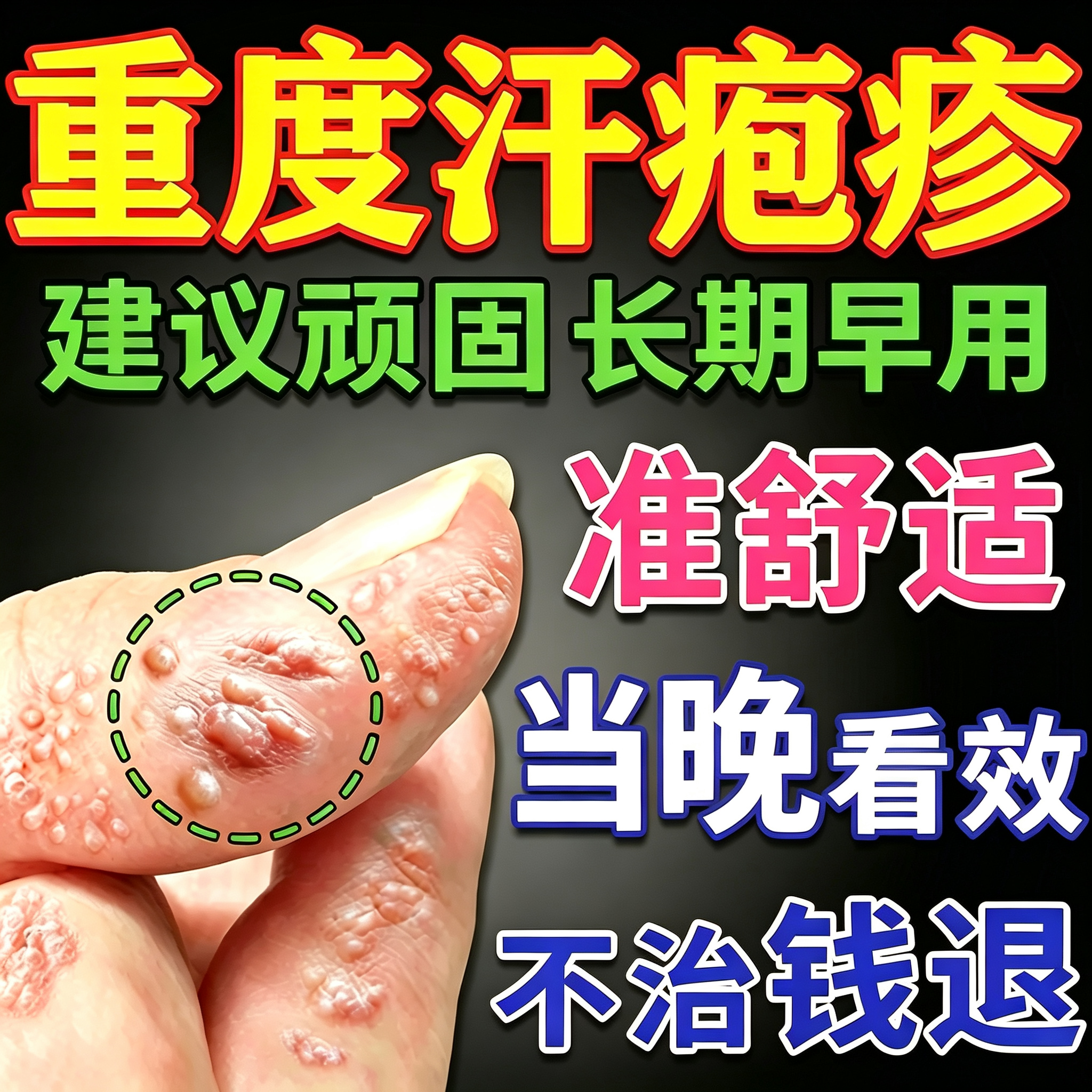 汗疱泡疹止痒根去专用膏药手上起小水泡汉状脱皮真菌感染抑菌软膏
