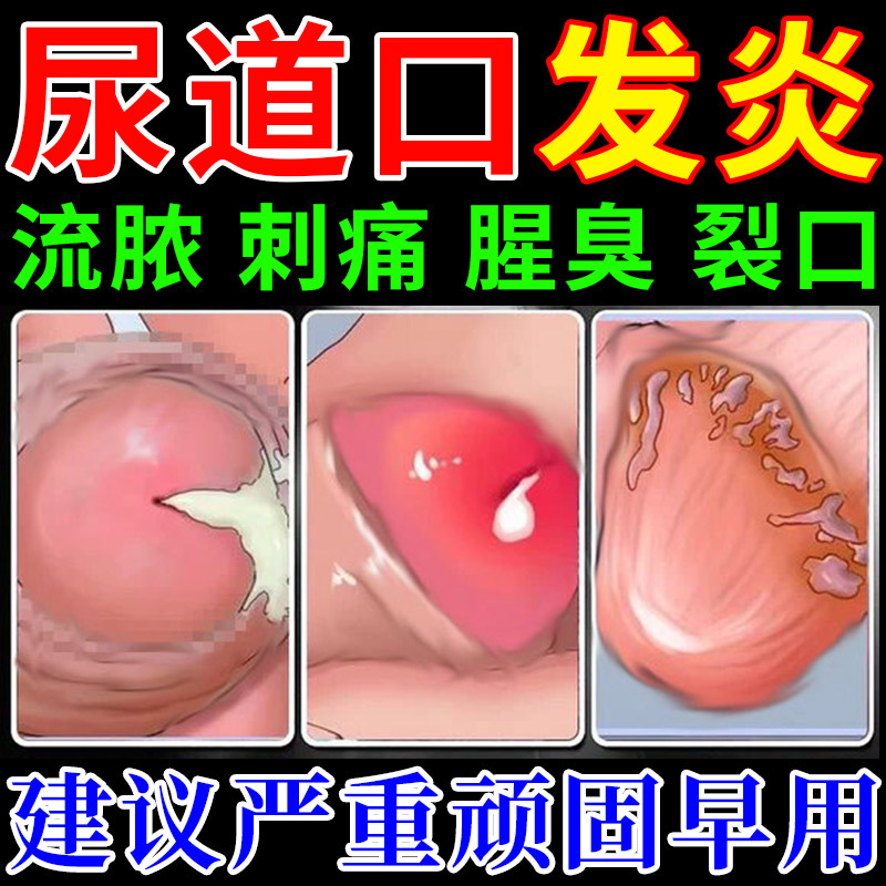 尿道炎尿路感染男性女性专用尿频尿痛夜尿泌尿系统淋梅清保健