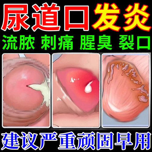 尿道炎尿路感染男性女性专用尿频尿痛夜尿泌尿系统淋梅清保健