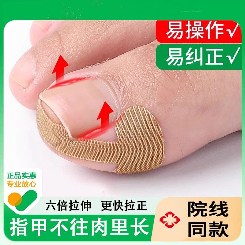 甲沟神器指甲矫正器纠正甲沟炎