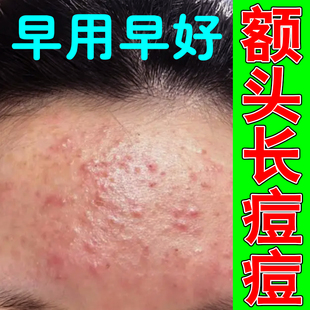 额头长痘痘严重脸上长痘青春痘专用草本乳膏额头痘痘红肿上火熬夜