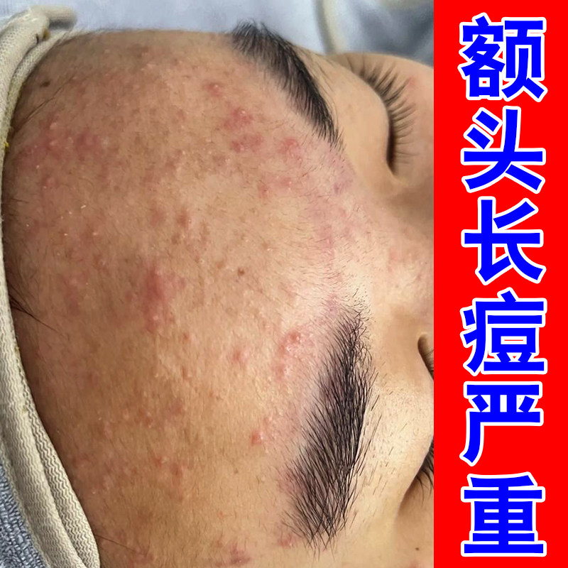 额头长痘严重痘印额头上长红肿痘痘闭口专用青春痘学生男女专用膏