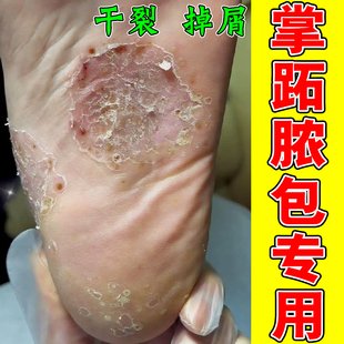 掌趾脓疱病症专用药手脚掌跖脓包角化脱皮干裂去死皮水泡痒软膏
