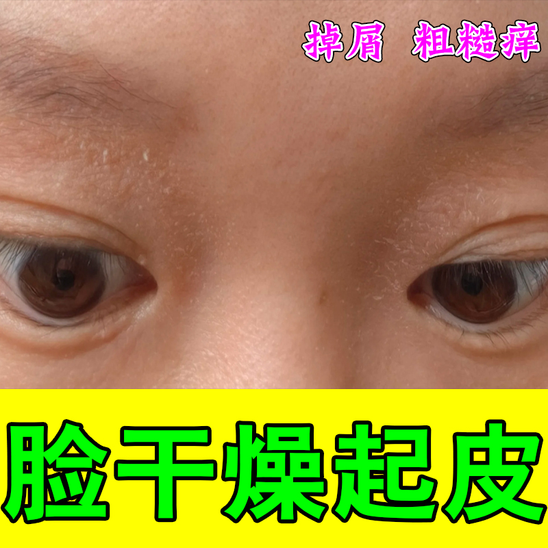 脸起皮干燥有碎屑痒起小疙瘩痘痘男士皮肤干燥红痒嘴角下巴爆皮痒