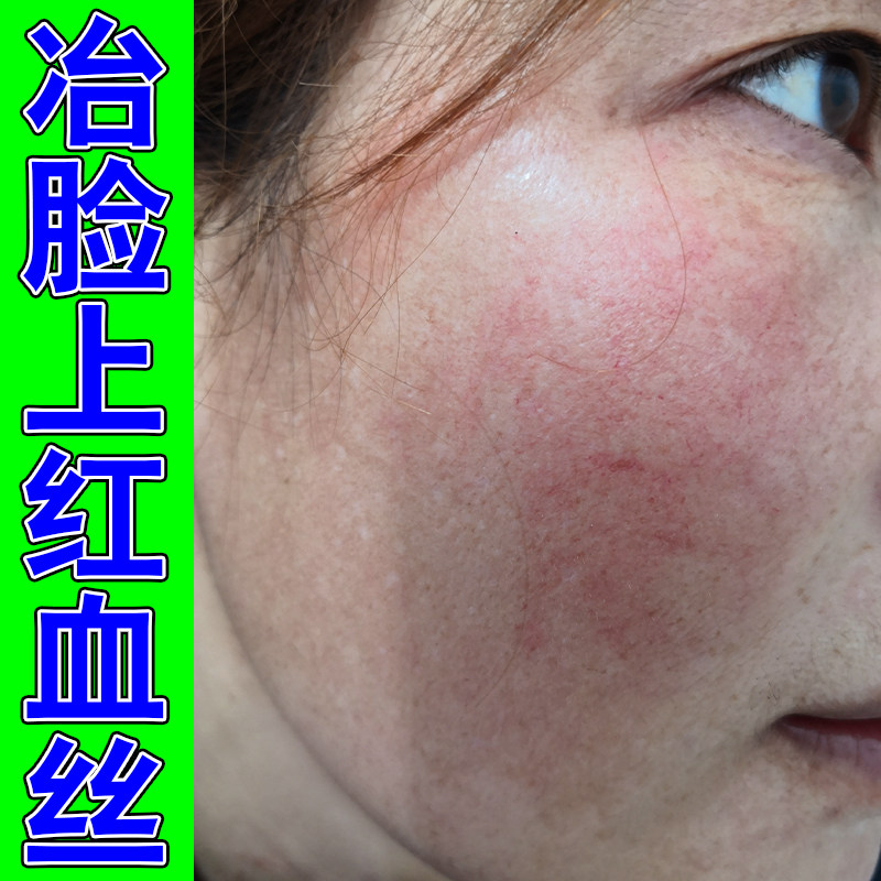 冶脸上红血丝严重修复角质层脸部皮肤消毒护理（消）