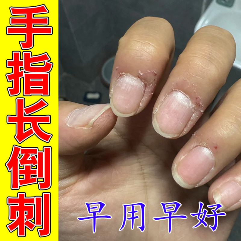 手指倒刺疼痛手指干燥粗糙掉屑指甲边缘长肉刺死皮撕裂脱皮修护膏