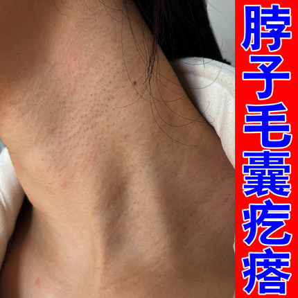脖子毛囊疙瘩皮肤粗糙小颗粒手臂脖子毛囊堵塞小黑点摸起来粗糙