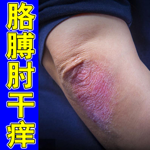 手肘皮肤痒胳膊肘长疹子起红疙瘩湿痒神经性干燥脱屑专用