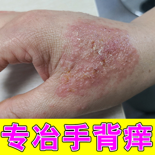 手背起皮干痒小水泡湿痒手上长疱汗疹汉状真菌干裂脱皮感染膏