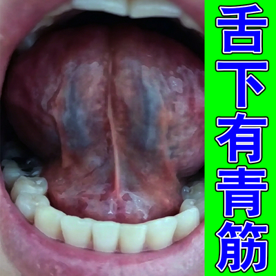 舌底部血管怒张口腔溶栓舌下青筋又黑又粗淤血疏通血液不流通喷剂