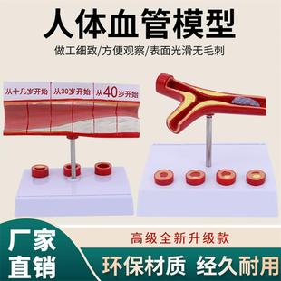 冠状动脉性心血管动脉模型硬化模型老年心脏模型血栓模型