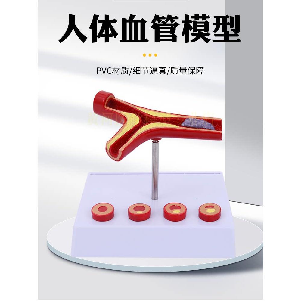血栓模型 人体支脉粥样 硬化动脉心血管 各阶段年龄血管展示模型