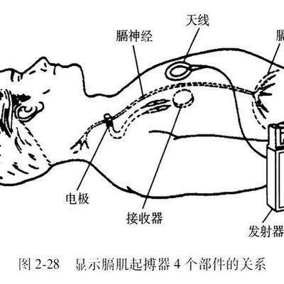 变频便携式体外膈肌起搏器