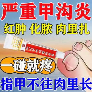 甲沟炎药膏甲沟感染发炎红肿化脓脚指甲长肉粒曲安奈德益康唑乳膏