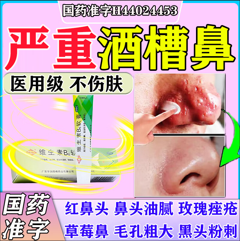 酒糟鼻药膏红鼻子去红血丝黑头收缩毛孔除螨虫粉刺维生素B6软膏