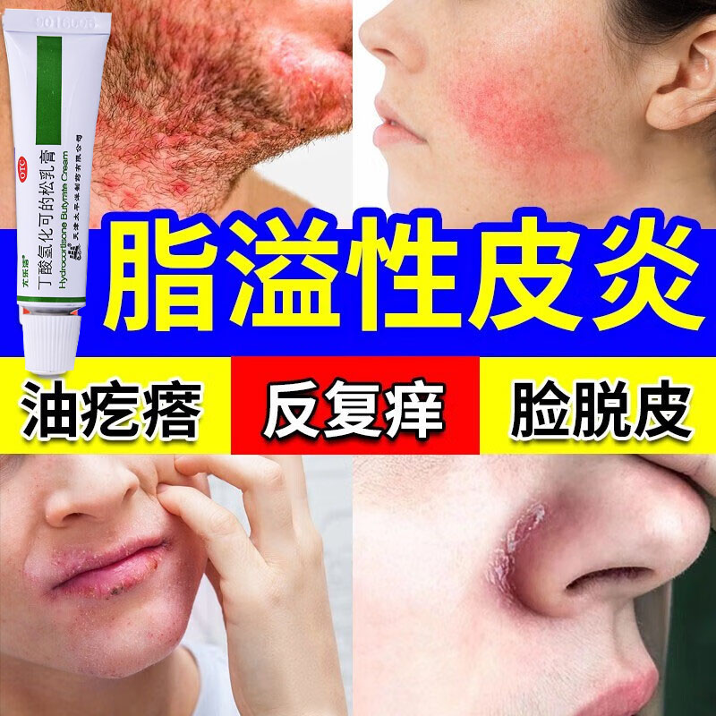 脂溢性皮炎软膏头皮屑脂溢性皮炎真菌感染头癣丁酸氢化可的松软膏