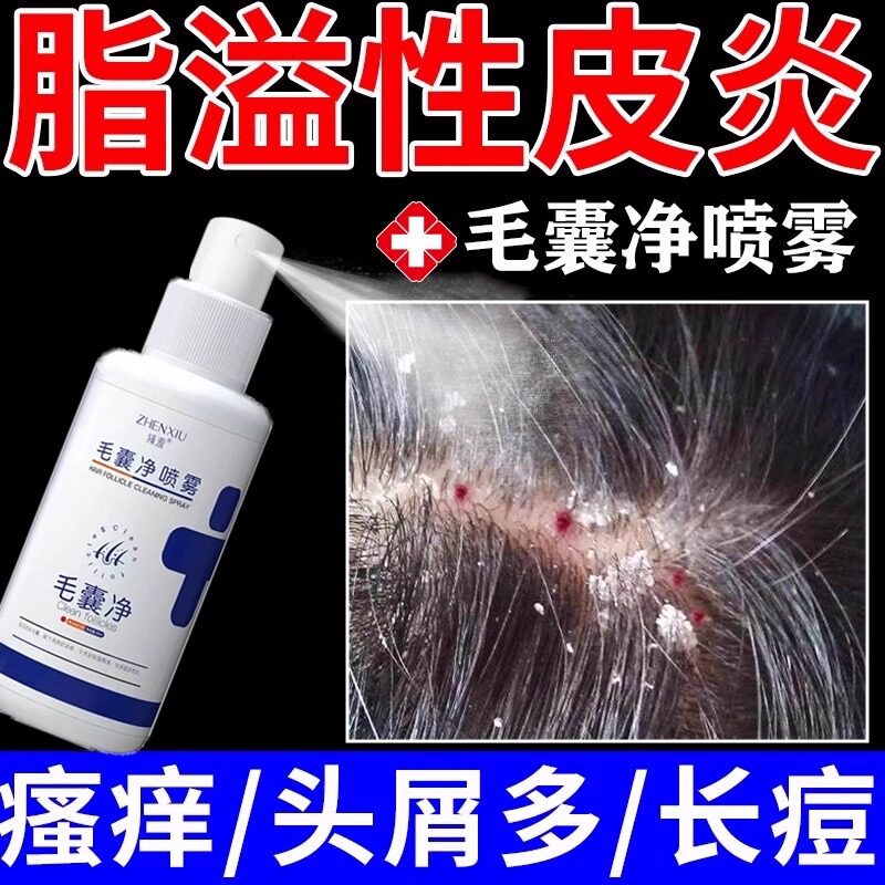 脂溢性皮炎头部喷剂止痒头屑头痒专用真菌感染头皮癣毛囊炎喷雾LL