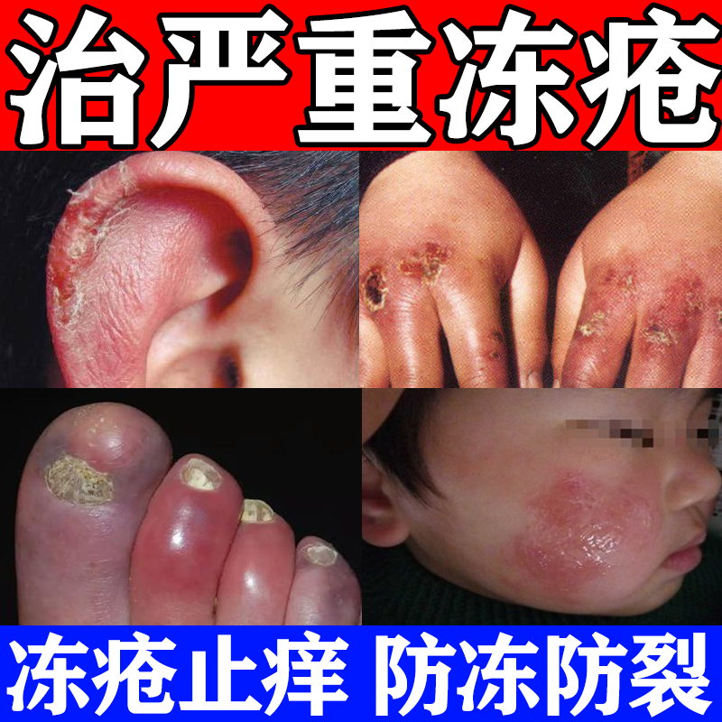 【川石】冻疮膏3%5%5%*20g*1支/盒