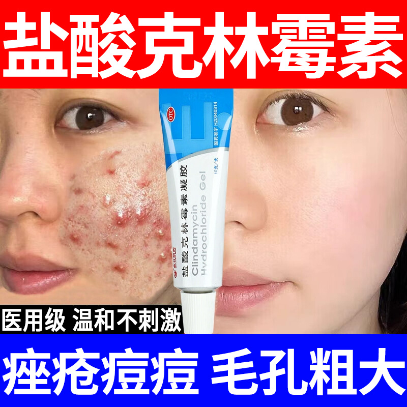 官方正品OTC盐酸克林霉素凝胶医用治疗痤疮祛痘痘软膏祛痘印药膏W