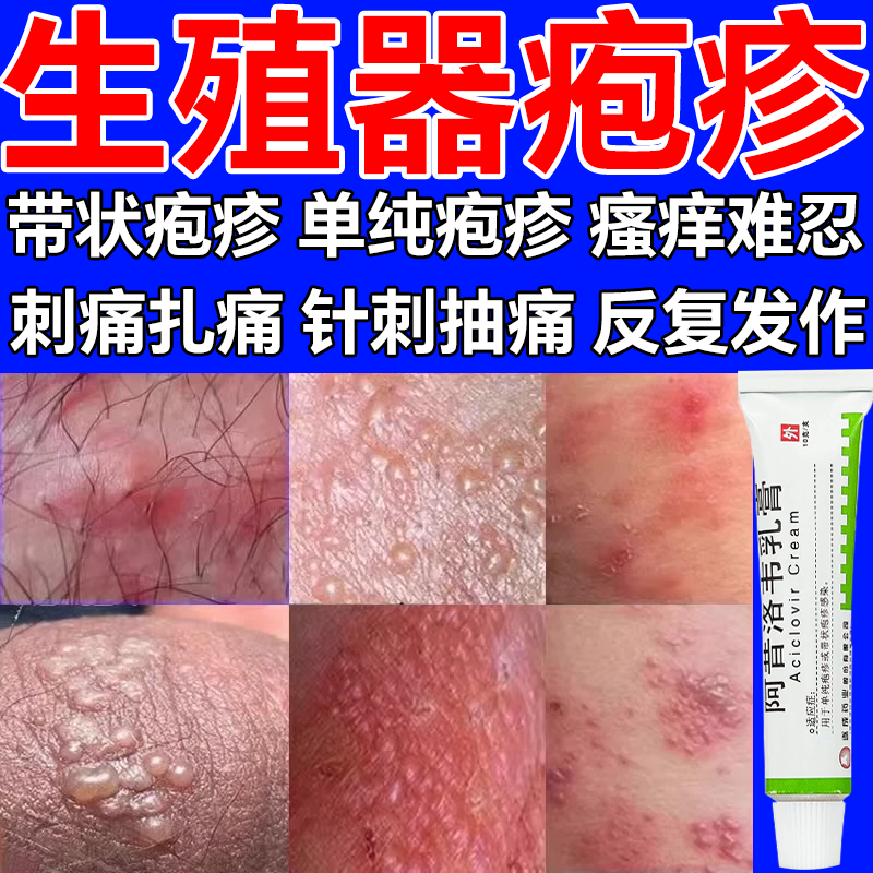治疱疹药膏生殖器嘴唇疱疹软膏抗病毒水痘单纯疱疹阿昔洛韦乳膏w