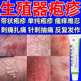 治疱疹药膏生殖器嘴唇疱疹软膏抗病毒水痘单纯疱疹阿昔洛韦乳膏w