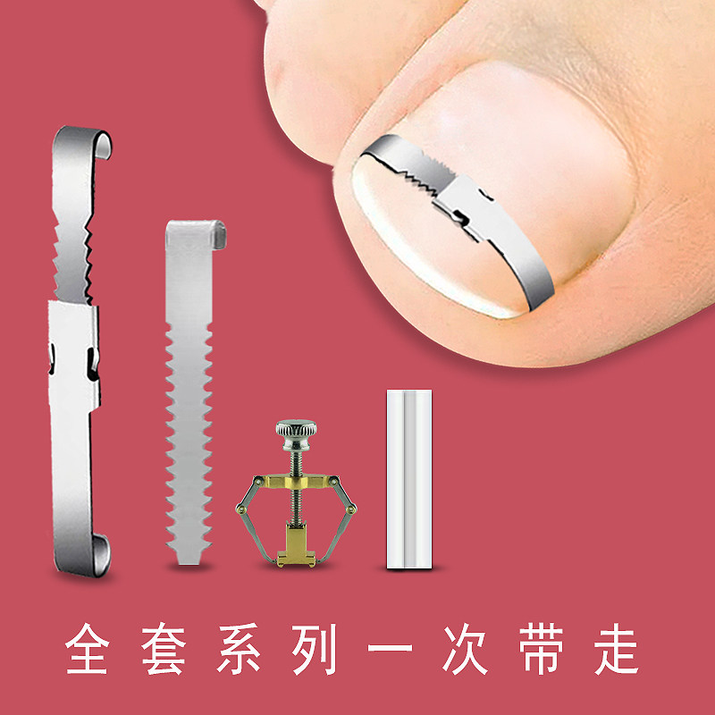 甲沟矫正器嵌甲矫正器脚趾甲卷指甲纠正神器正甲扣拉拉炎正甲贴片