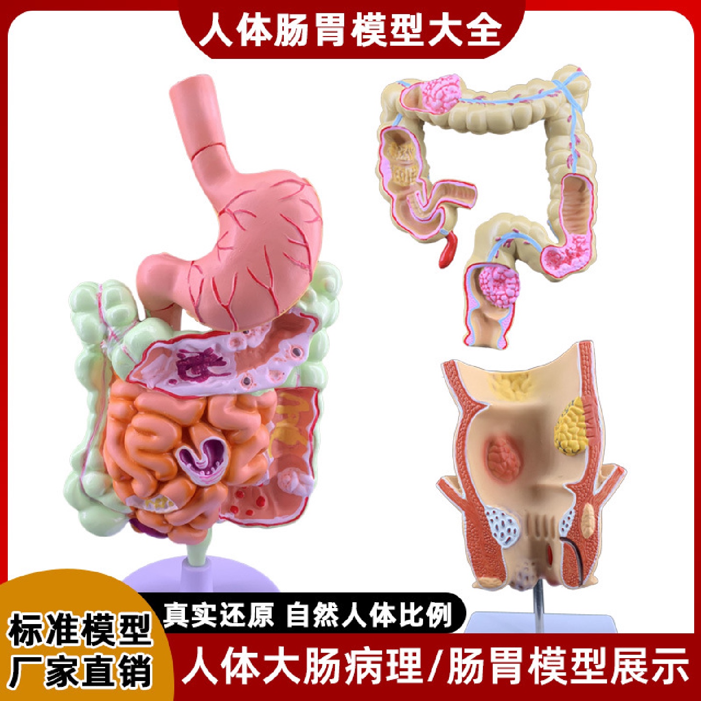 人体大肠病理模型肠胃解剖模型病态大肠盲肠直肠十二指肠模型