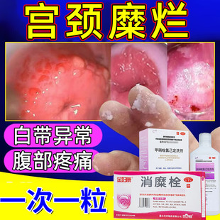 消糜栓阴道炎妇科用药 瘙痒 治疗二度三度宫颈糜烂的重度专用中药