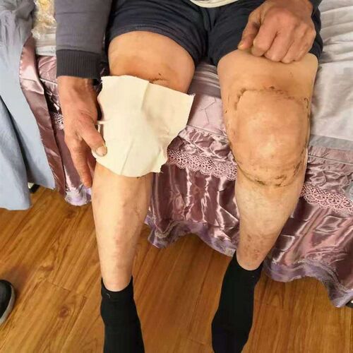 泰安肥城老安驾庄梁氏梁老老腰间盘踝膝关