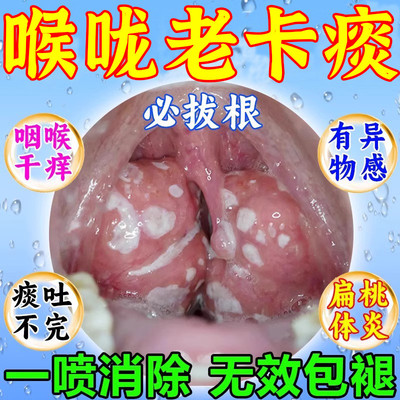 喉咙卡痰嗓子有异物感痰多吐不完粘嗓子不舒服老有痰咽喉化痰喷剂