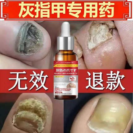 治疗灰指甲专用药水正品官方旗舰店真菌感染非特效日本第1一名BF