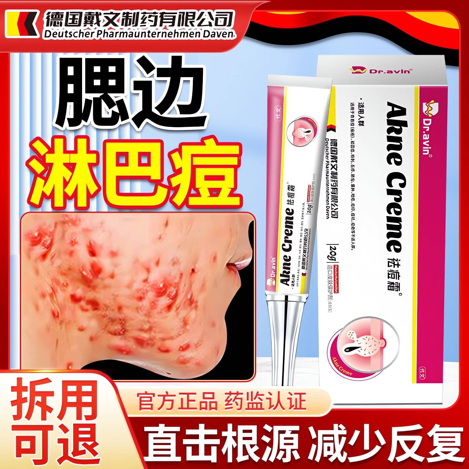 边上淋巴痘专用凝胶DQV结下巴反复脸长痘腮帮子痤疮节硬腮块痘药