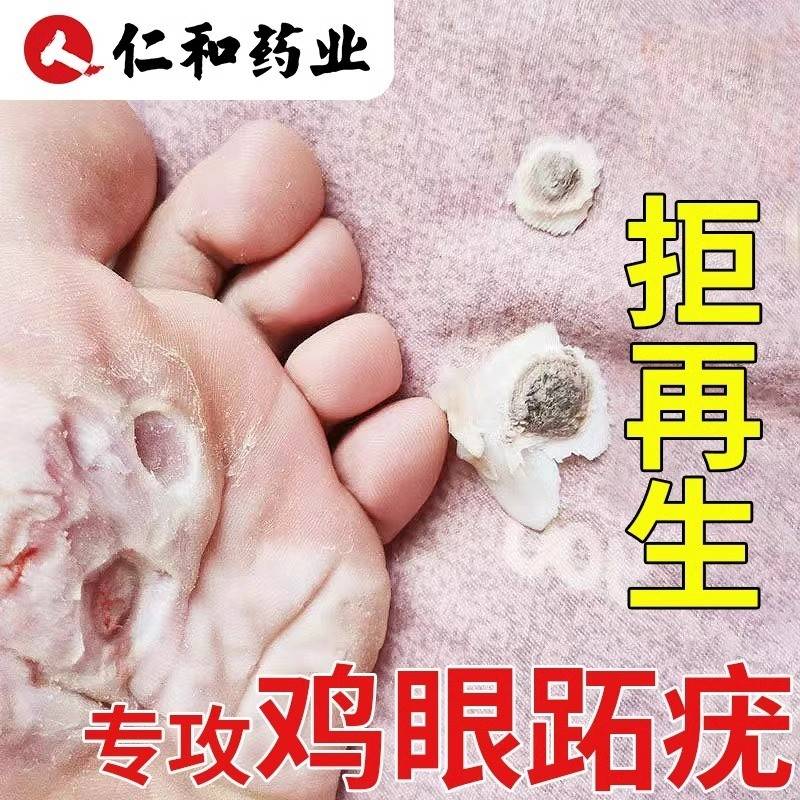 鸡眼贴去除疣DXT瘊肉粒鸡扁平疣净专药用丝状一抹忧趾眼疣克药无