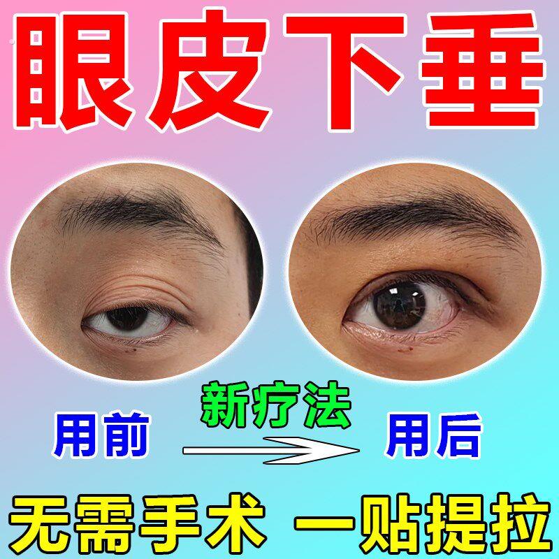 眼皮下垂提拉眼膜双眼皮神器上眼睑防松弛紧致大小眼矫正器专用贴