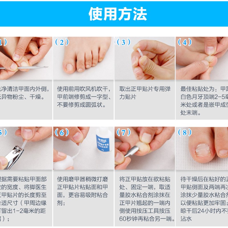 脚医生正甲片甲沟嵌甲矫正器脚趾甲往肉里长红肿软甲炎