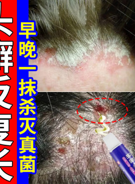 头癣药膏治头皮癣头部红斑瘙痒真菌感染结痂屑硝酸咪康唑乳膏正品