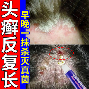 头癣药膏治头皮癣头部红斑瘙痒真菌感染结痂屑硝酸咪康唑乳膏正品