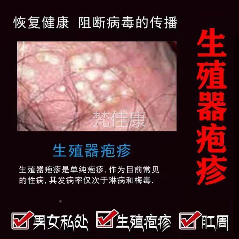 生殖器疱BBC疹药断树根疱疹克h星进口pv素臼鬼毒酊mf尖锐湿疣防复