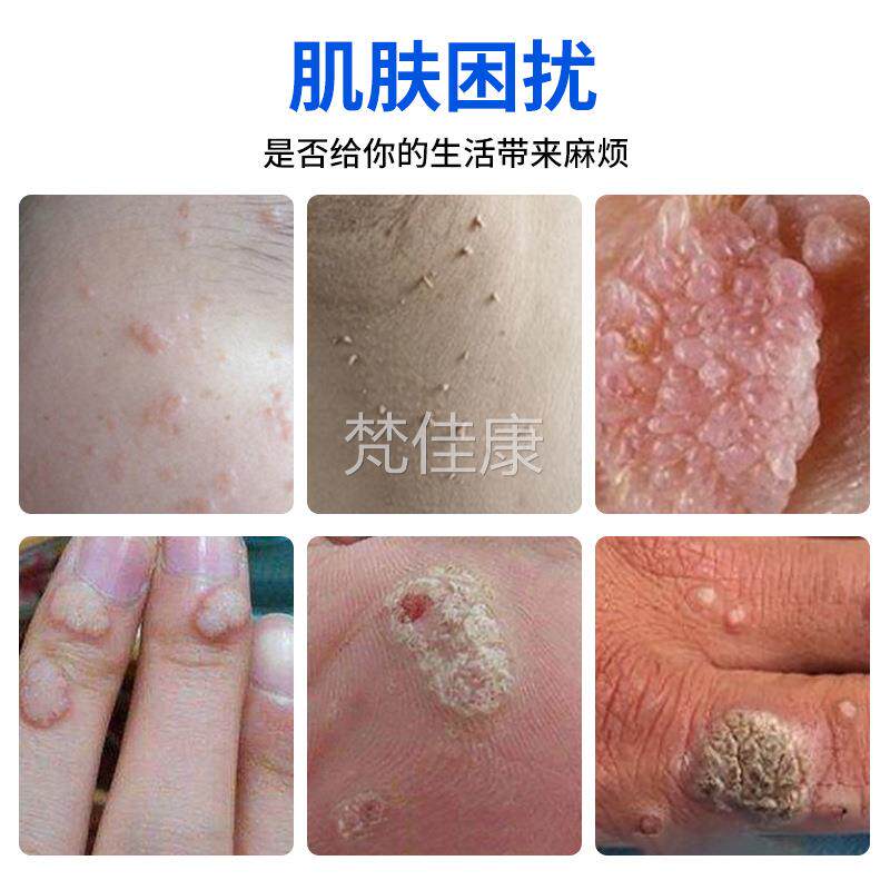 邹安5扁%润咪奎膜特乳百草本克尤膏去除平丝状尖锐湿尤老膏茧OOX