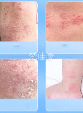 南本草云南真菌王云官方旗舰店瘙ZBP正全品手足脚后跟身皮肤涂痒