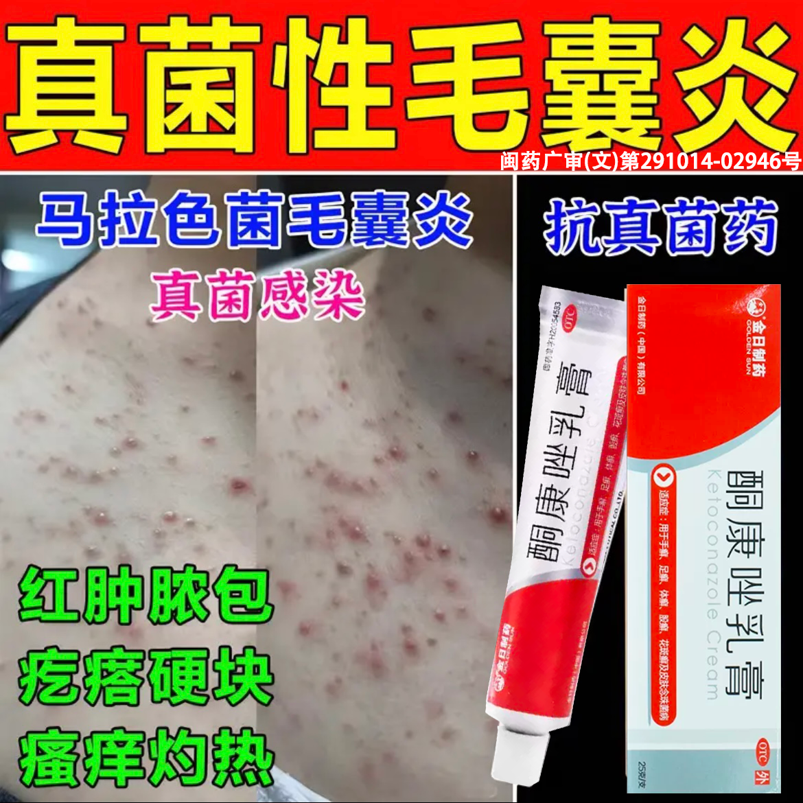 酮康唑乳膏正品治疗毛囊炎专用药膏马拉色菌抗真菌性毛囊炎痘痘