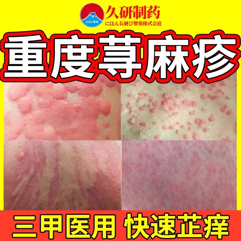 寻荨麻疹过敏止断急性痒丘疹性胆