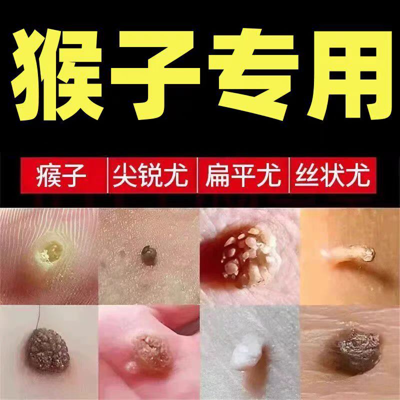 【药房直售】优瘊克膏无痛脱落