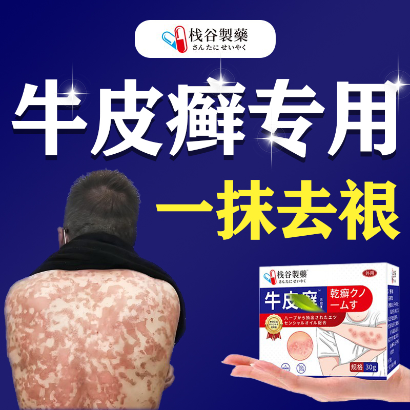 顽固性牛皮癣藓银屑病专进口用瘙痒止痒治疗软膏皮肤癣银屑克星