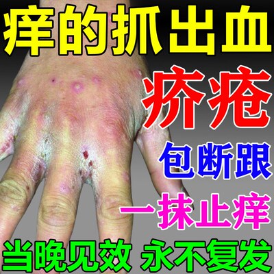 疥疮膏疥疮专用特效药疥疮结节皮肤剧烈瘙痒丘疹水泡硫磺软膏30%